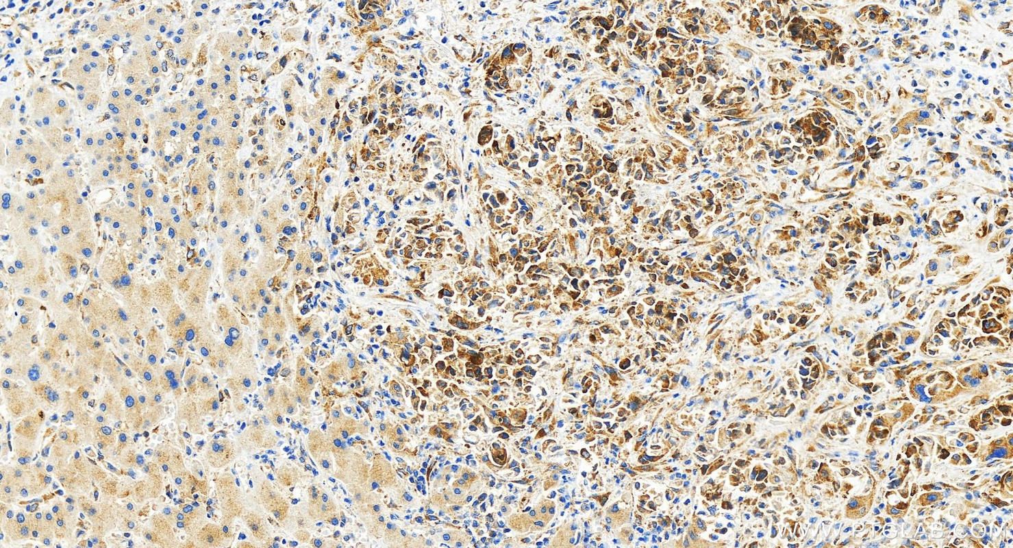 IHC staining of human intrahepatic cholangiocarcinoma using 82080-6-RR