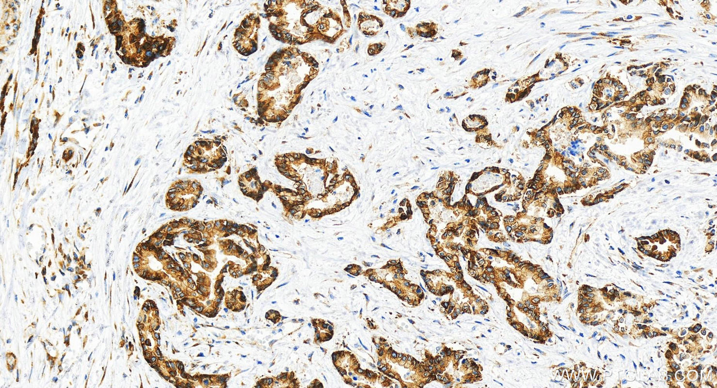 IHC staining of human intrahepatic cholangiocarcinoma using 82080-6-RR