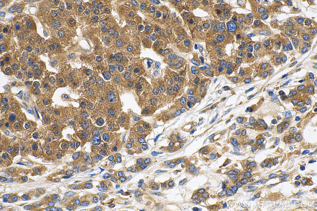 IHC staining of human pancreas cancer using 14367-1-AP