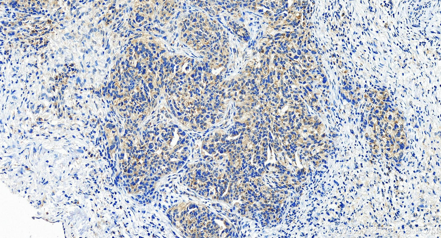 IHC staining of human ovary cancer using 22439-1-AP