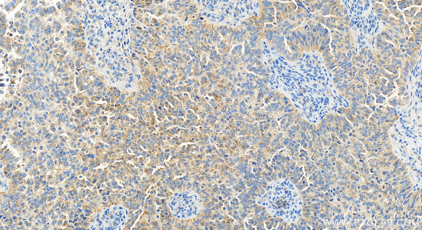 IHC staining of human ovarian  cancer using 83823-5-RR (same clone as 83823-5-PBS)