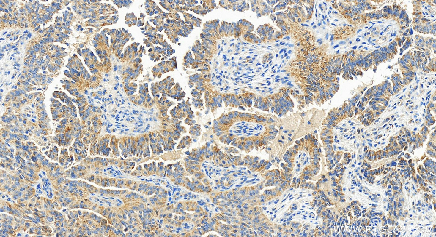 IHC staining of human ovarian  cancer using 83823-5-RR (same clone as 83823-5-PBS)