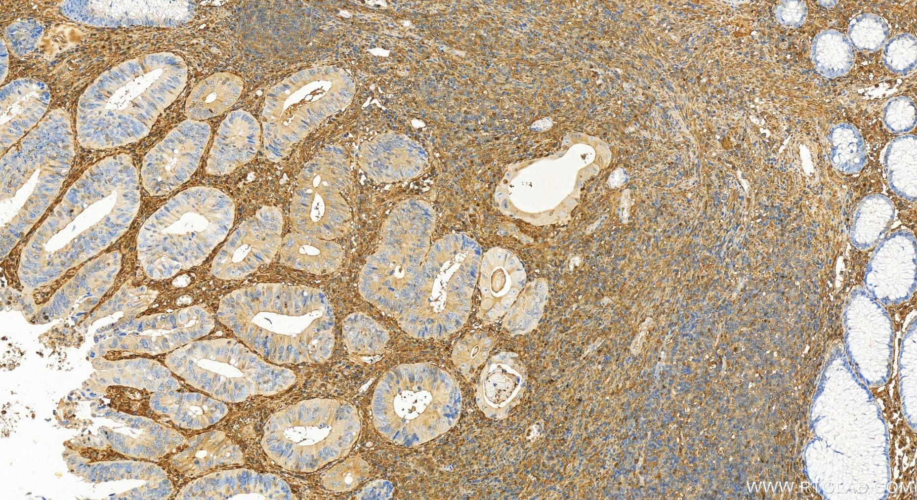 IHC staining of human colon cancer using 11858-1-AP (same clone as 11858-1-PBS)