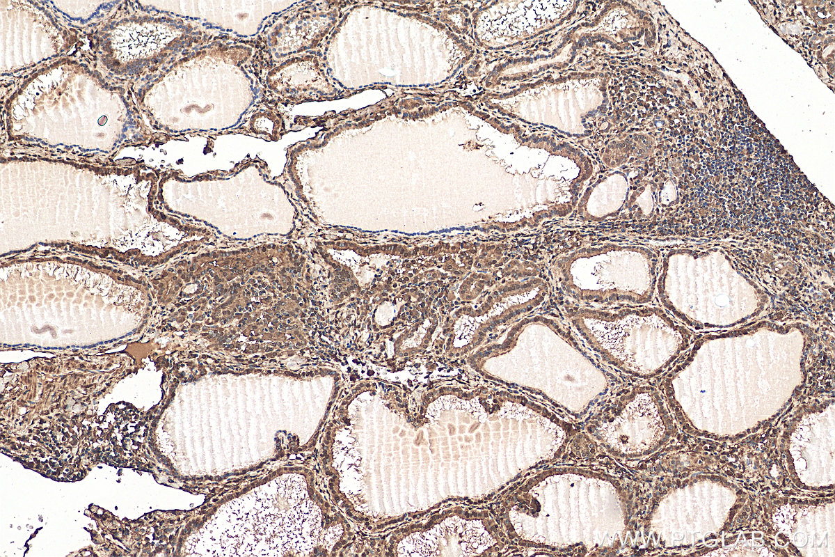 IHC staining of human thyroid cancer using 14979-1-AP