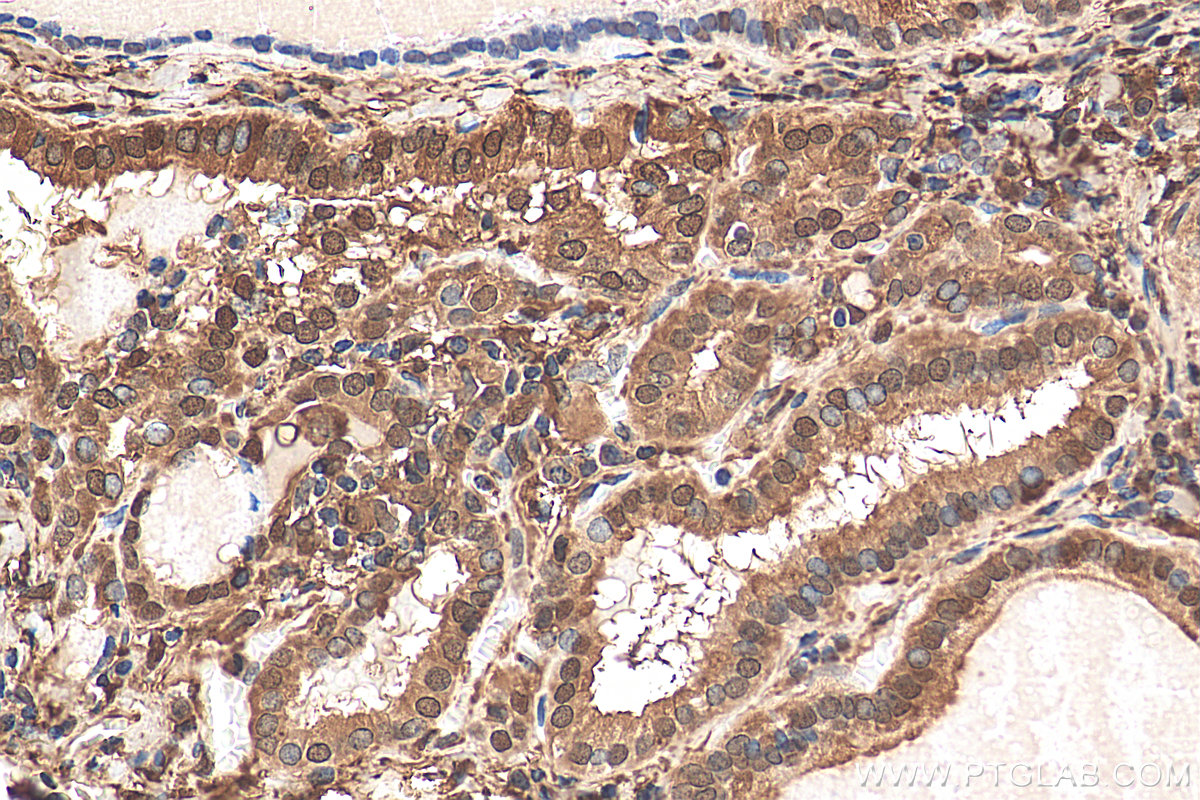 IHC staining of human thyroid cancer using 14979-1-AP