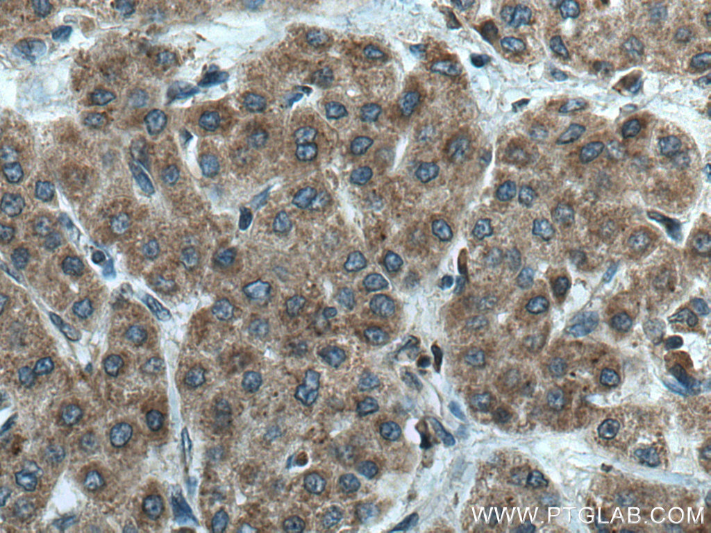 IHC staining of human liver cancer using 14933-1-AP