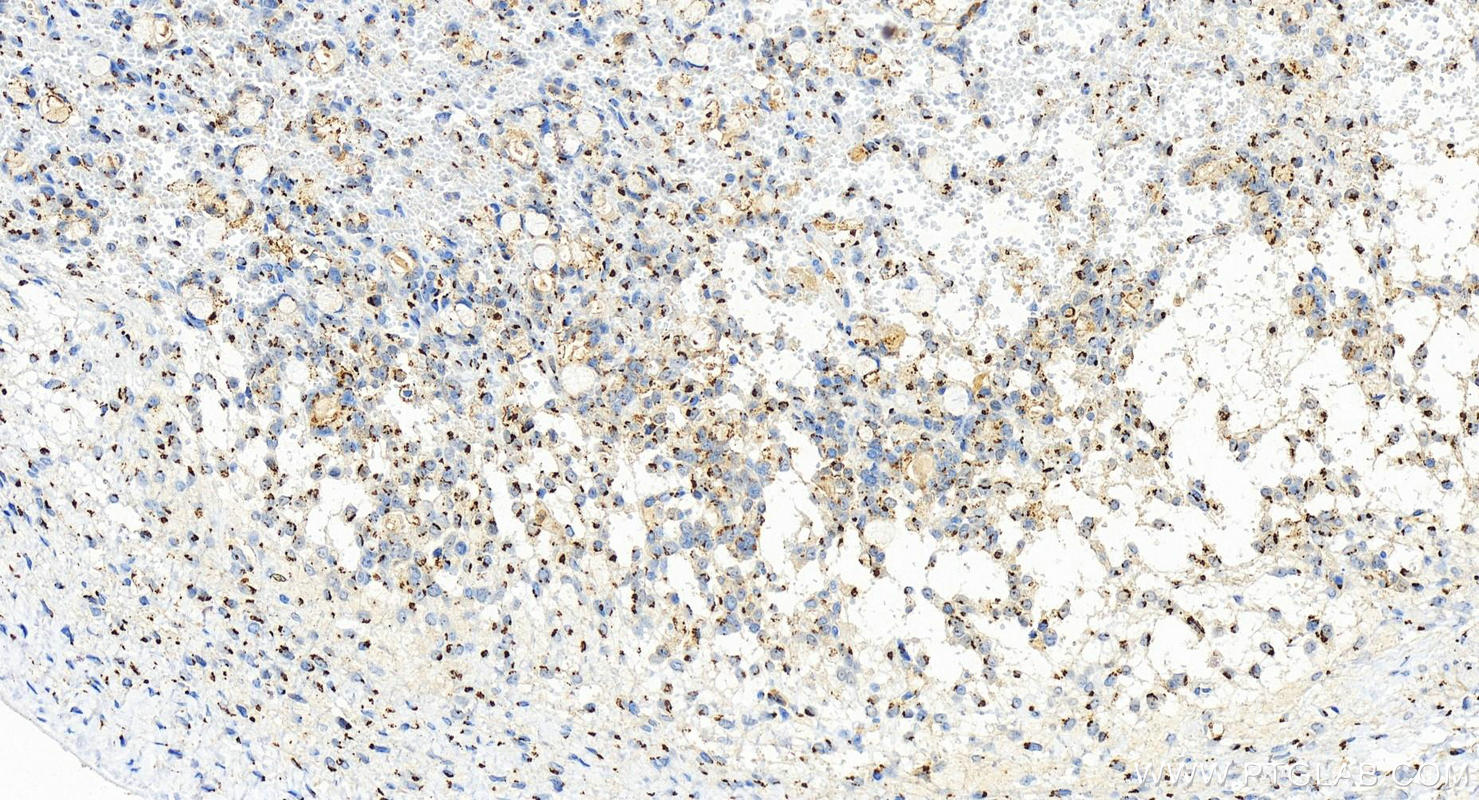 IHC staining of human ovary cancer using 83703-2-RR