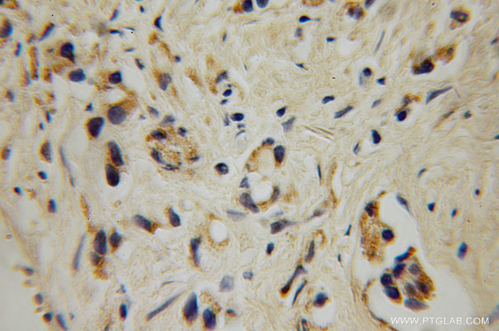 IHC staining of human prostate cancer using 12897-1-AP