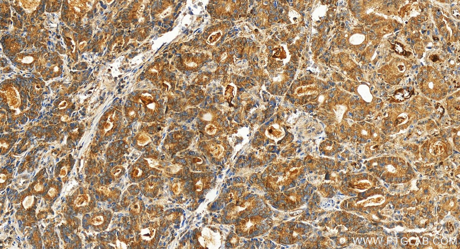 IHC staining of human stomach cancer using 25391-1-AP