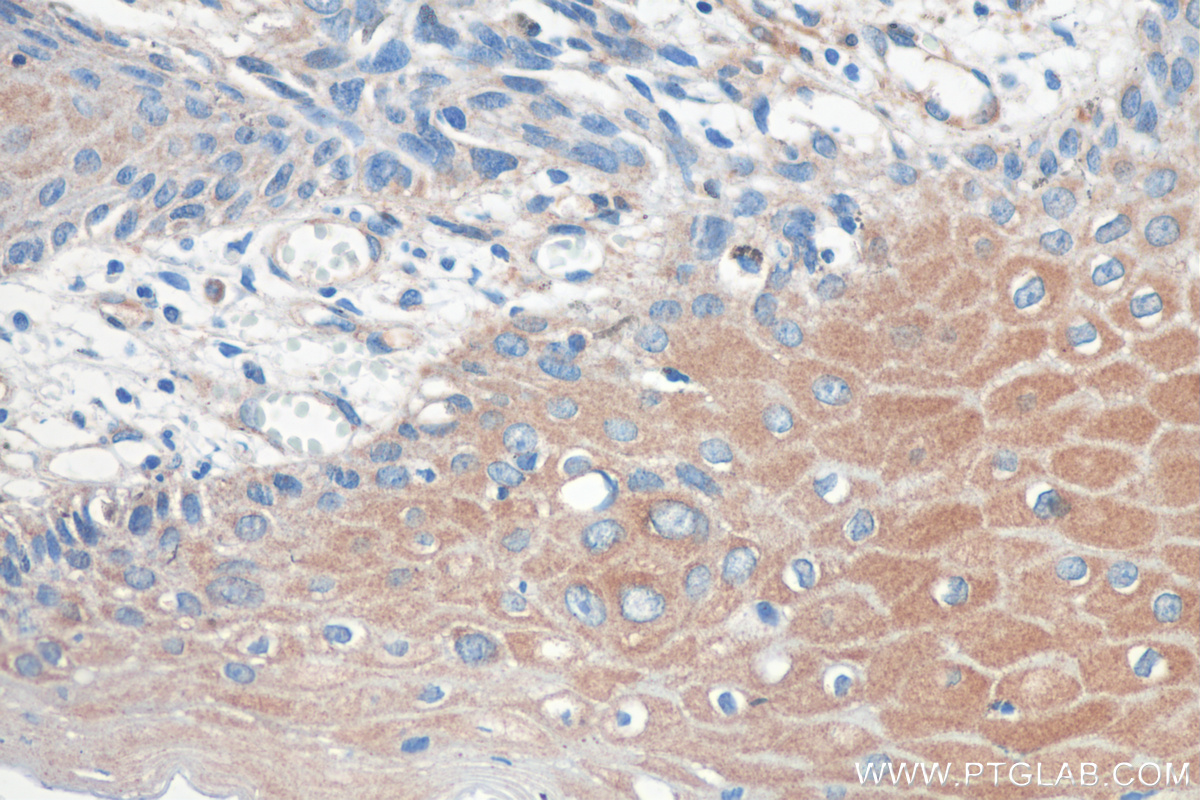 IHC staining of human skin cancer using 67893-1-Ig