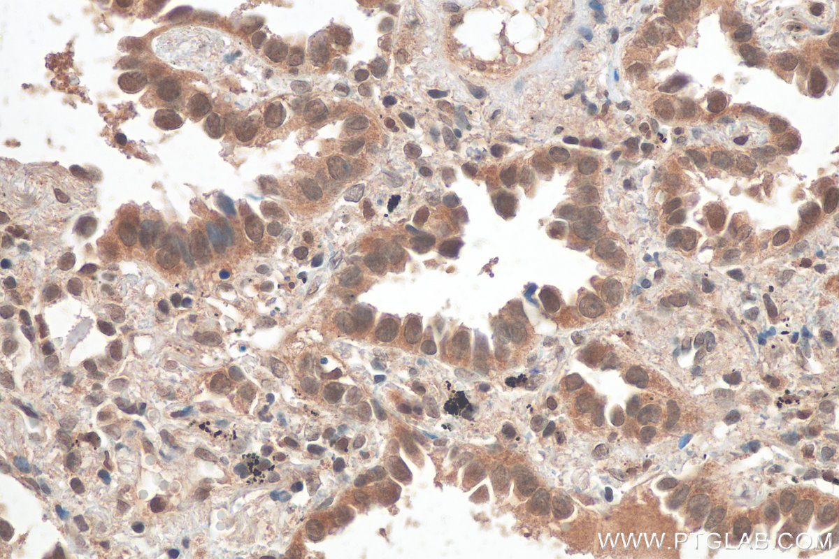 IHC staining of human lung cancer using 23001-1-AP