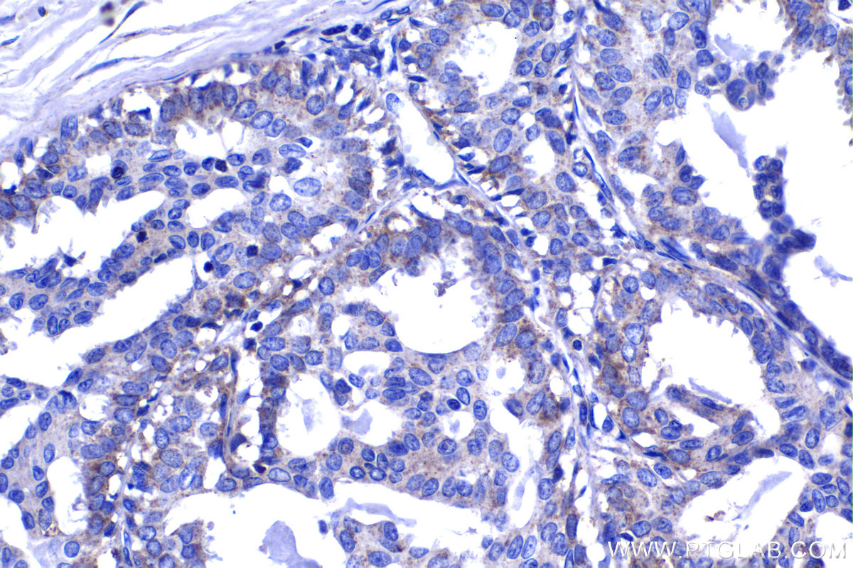 IHC staining of human breast cancer using 18118-1-AP