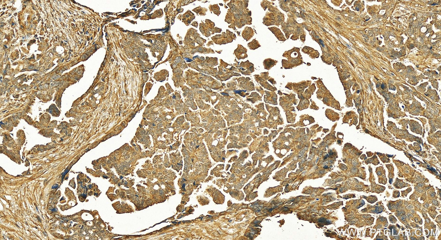 IHC staining of human ovary cancer using 16726-1-AP