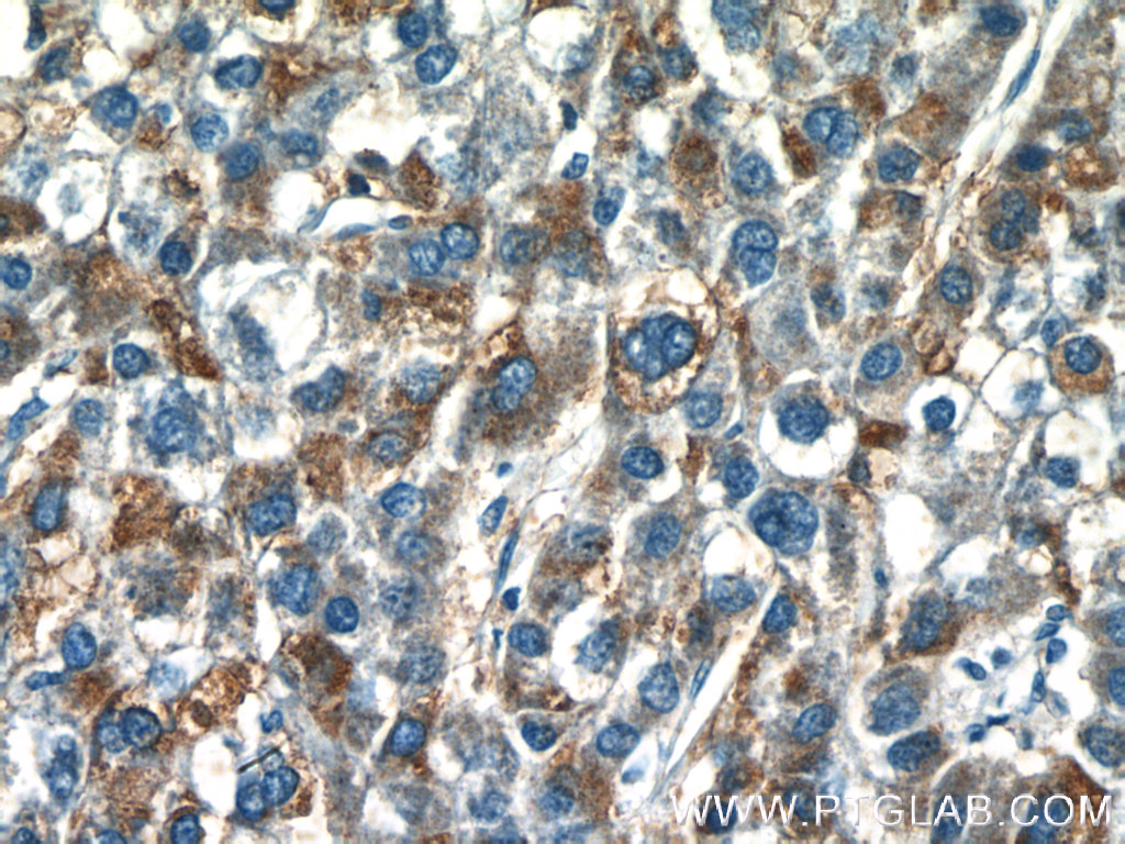 IHC staining of human liver cancer using 25074-1-AP