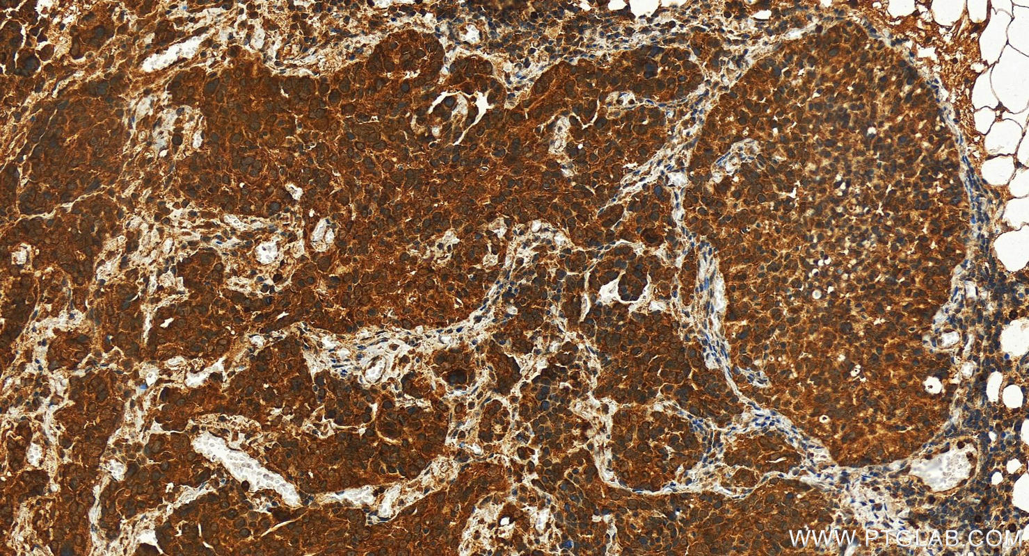 IHC staining of human ovary cancer using 10625-1-AP