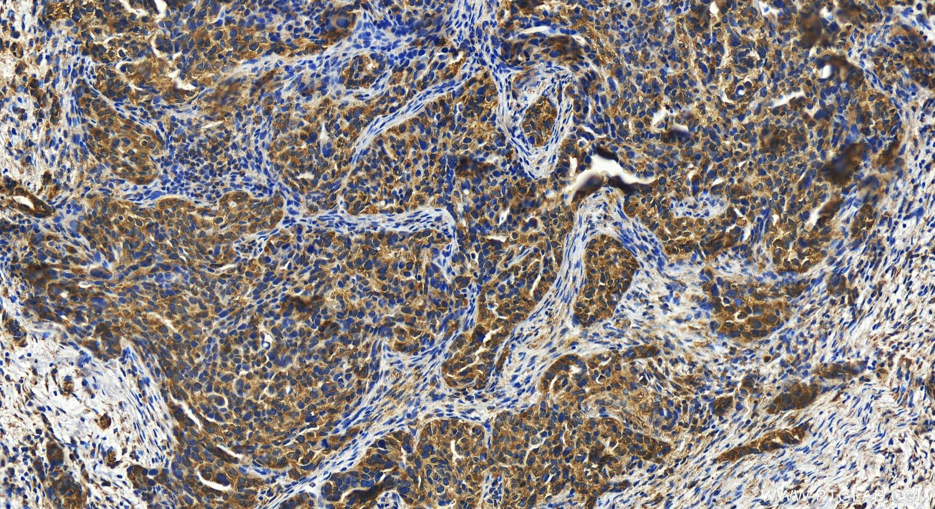 IHC staining of human ovary cancer using 15189-1-AP