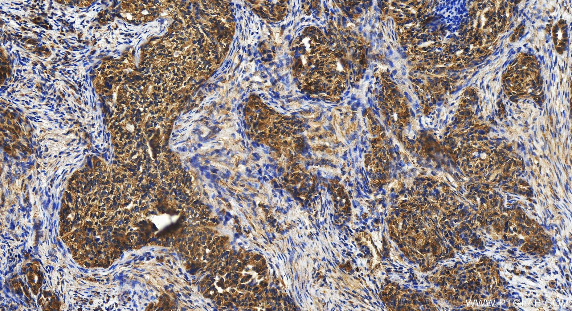 IHC staining of human ovary cancer using 15189-1-AP