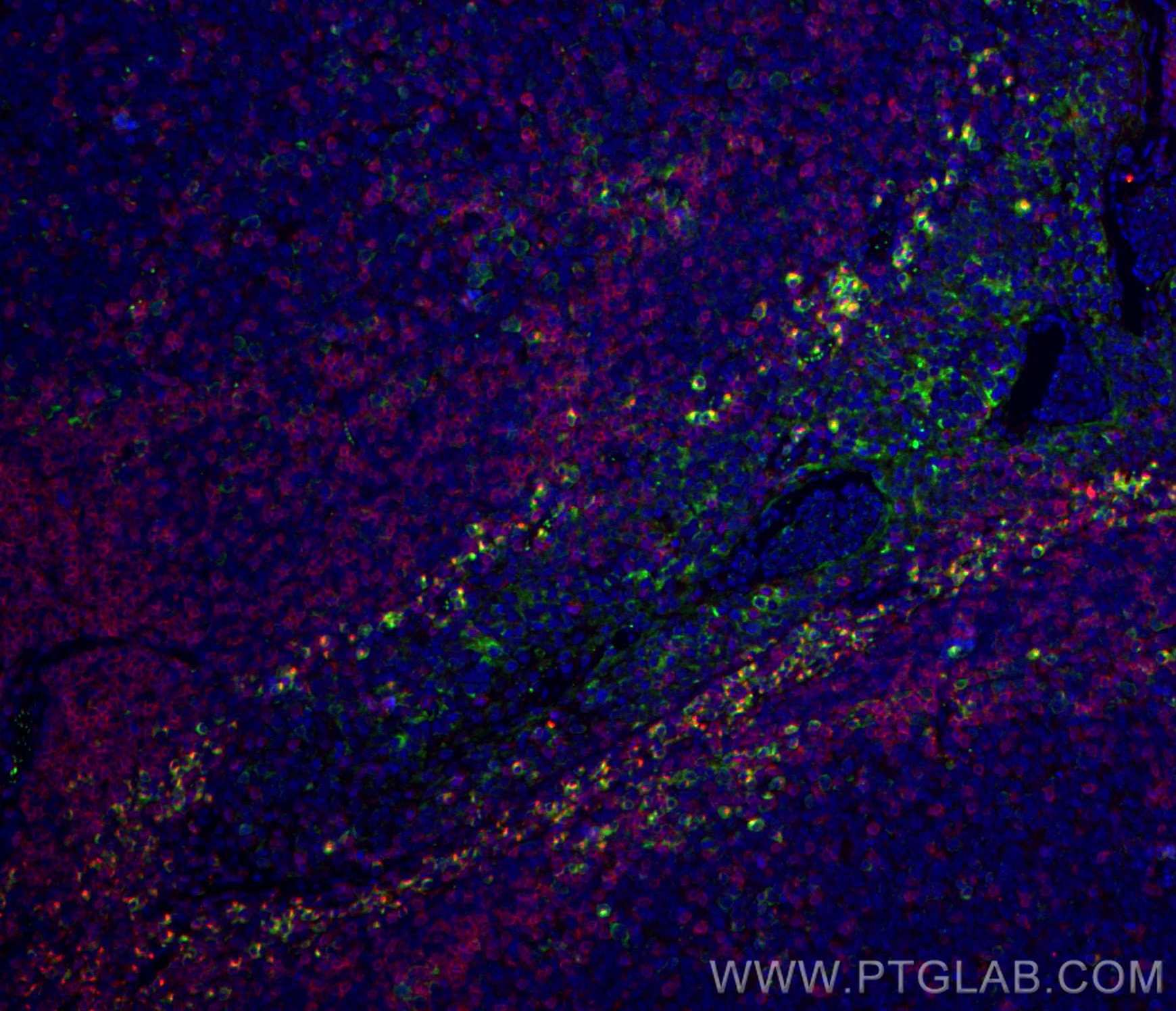 IF Staining of human tonsillitis using 24849-1-AP