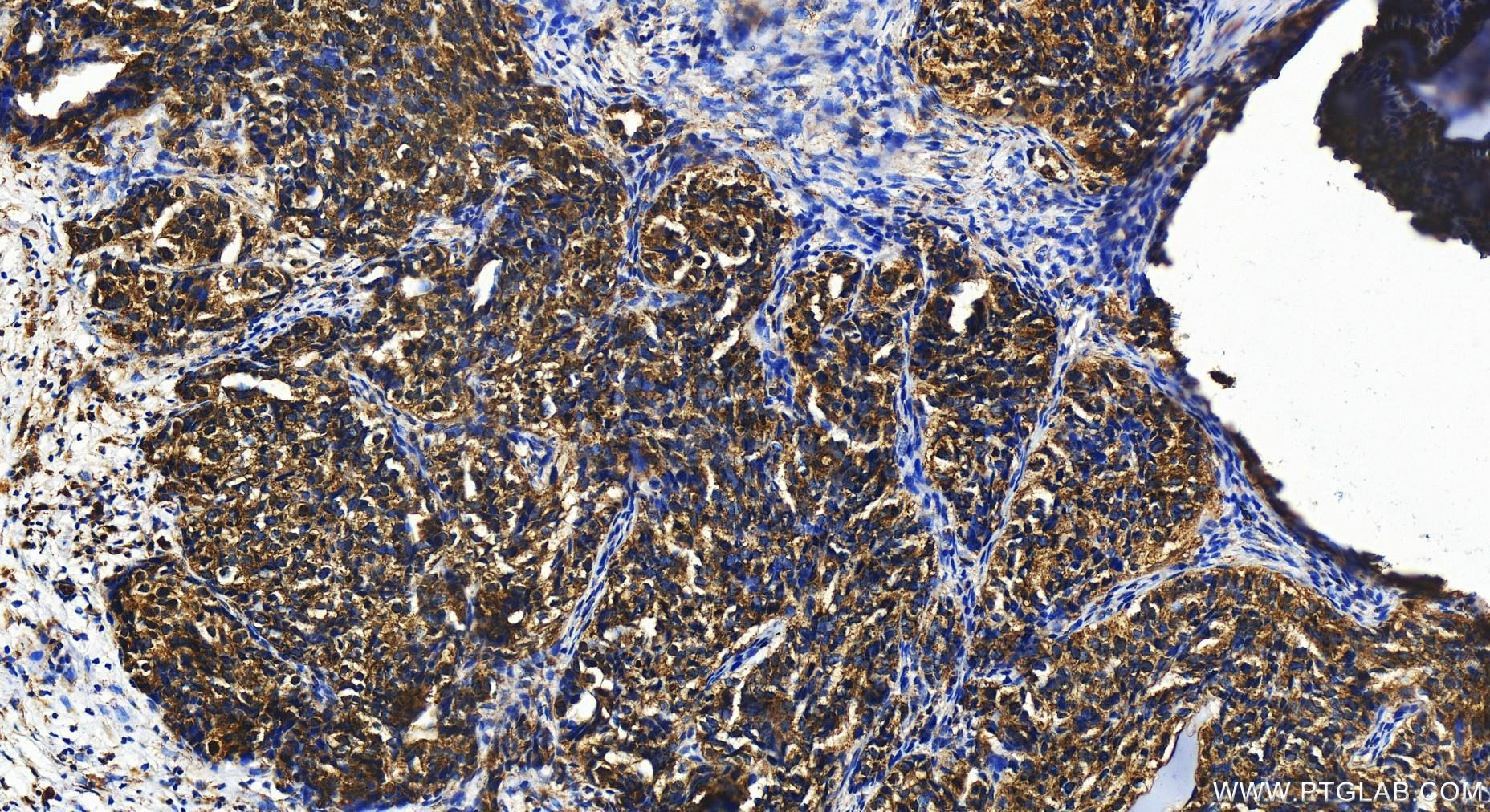 IHC staining of human ovary cancer using 16061-1-AP