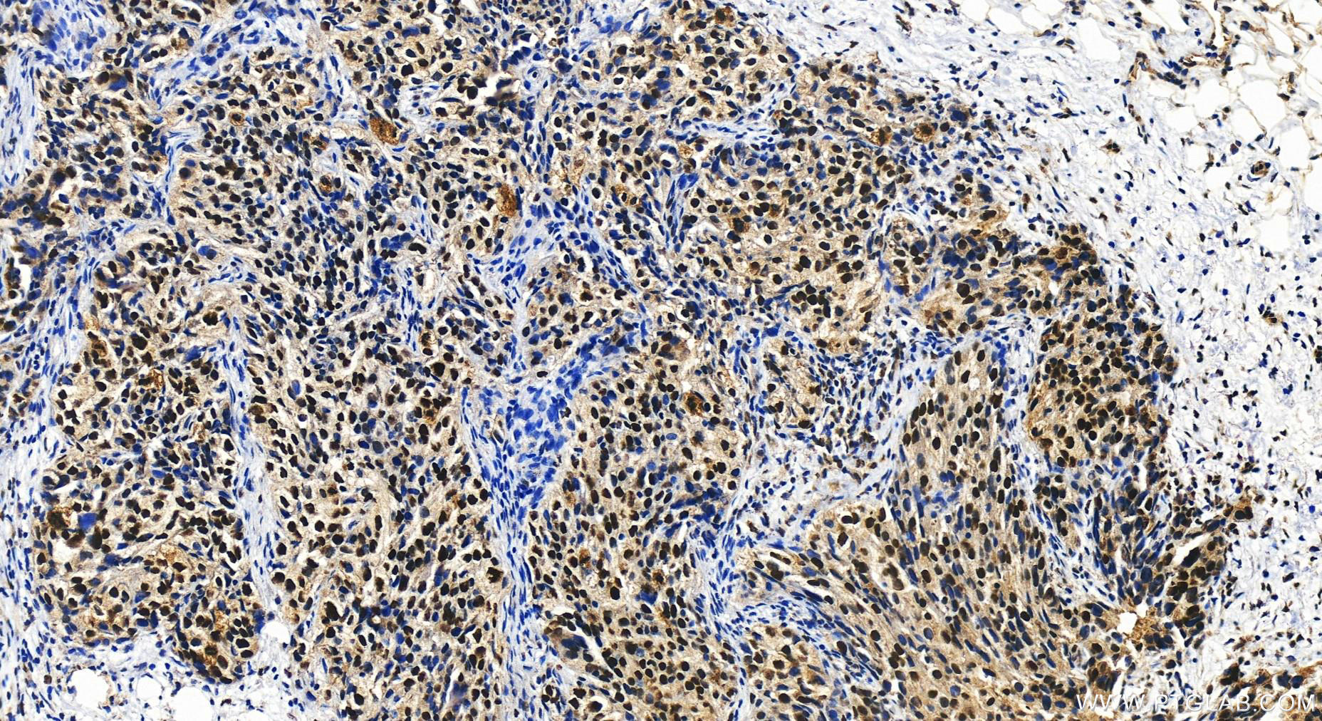 IHC staining of human ovary cancer using 16345-1-AP