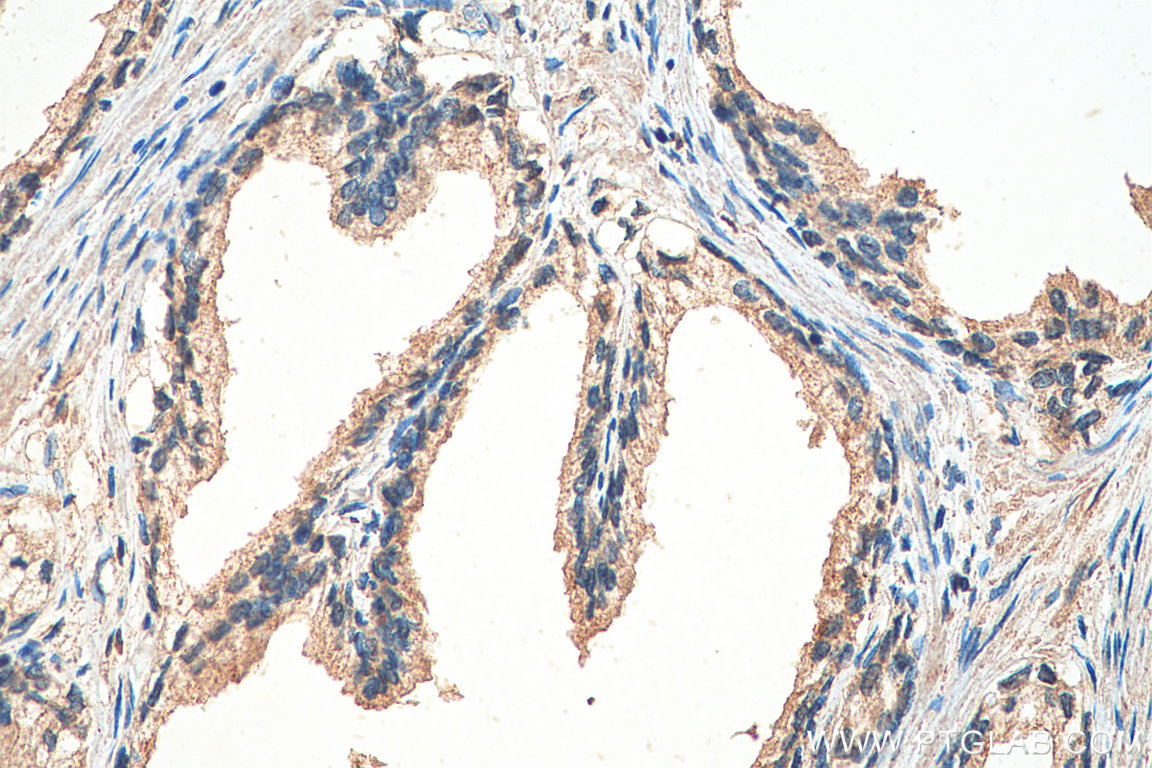 IHC staining of human prostate cancer using 67858-1-Ig (same clone as 67858-1-PBS)