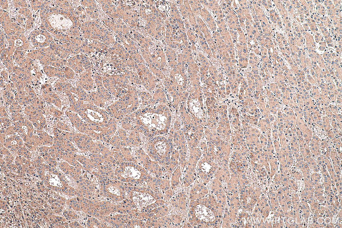 IHC staining of human liver cancer using 10450-1-AP