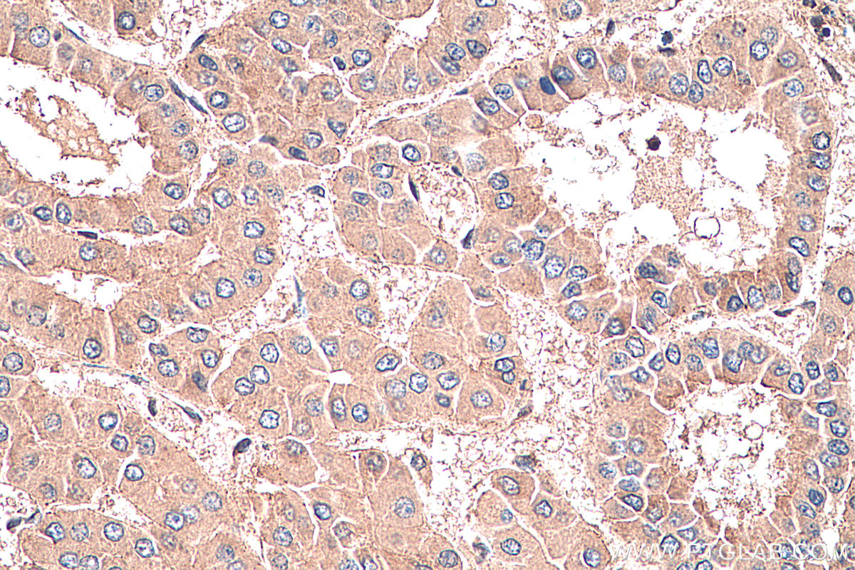 IHC staining of human liver cancer using 10450-1-AP