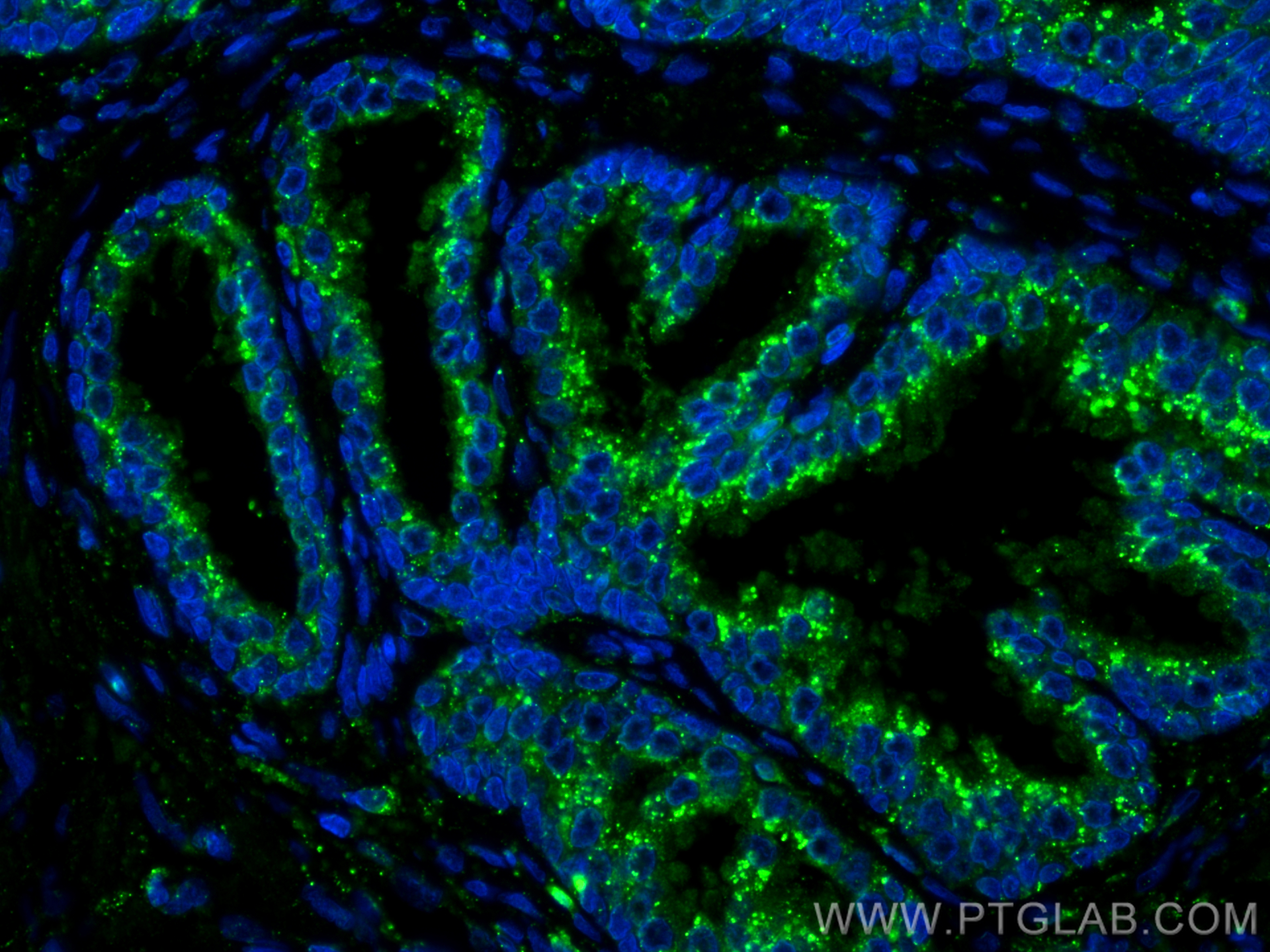 IF Staining of human prostate cancer using 15518-1-AP