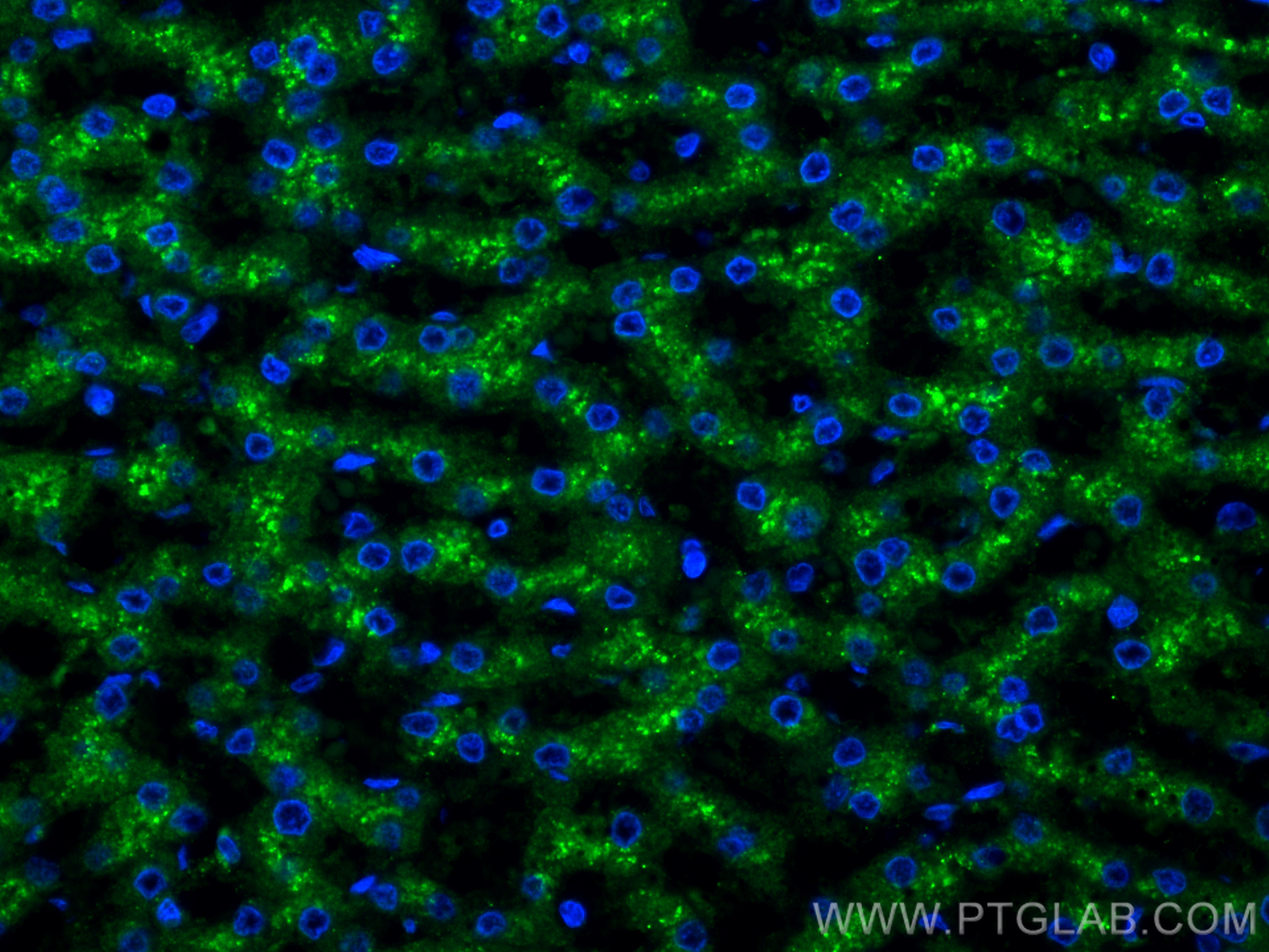 IF Staining of human liver cancer using 15518-1-AP