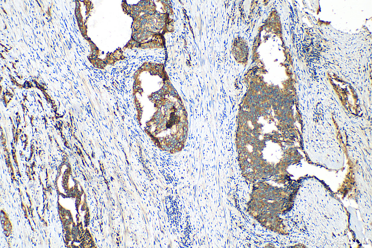 IHC staining of human prostate cancer using 15518-1-AP