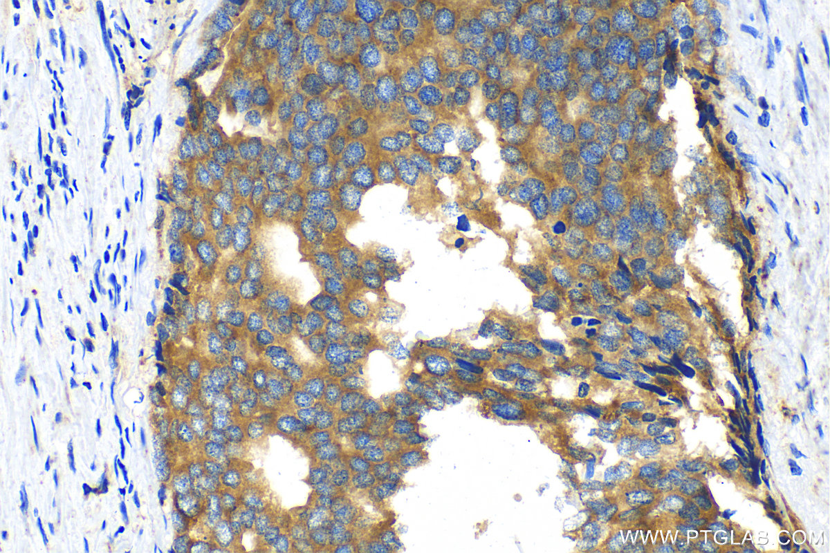 IHC staining of human prostate cancer using 15518-1-AP