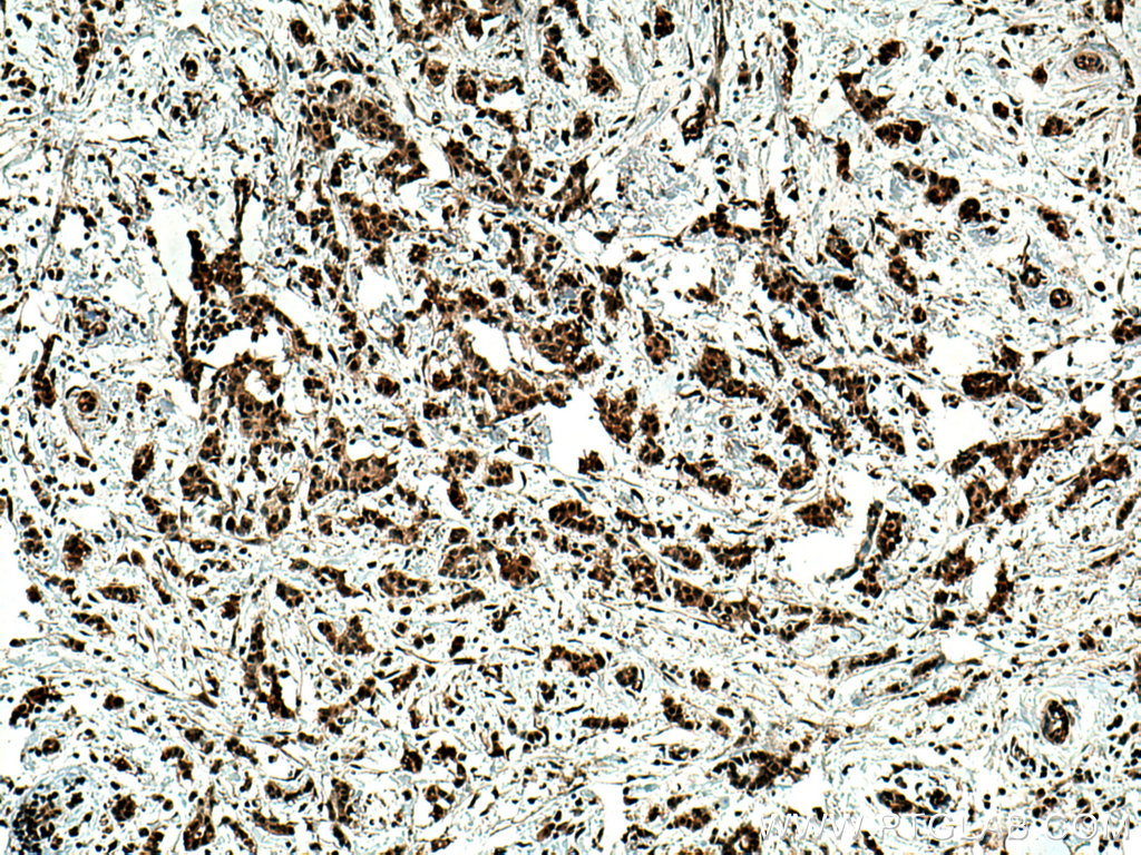 IHC staining of human breast cancer using 28245-1-AP