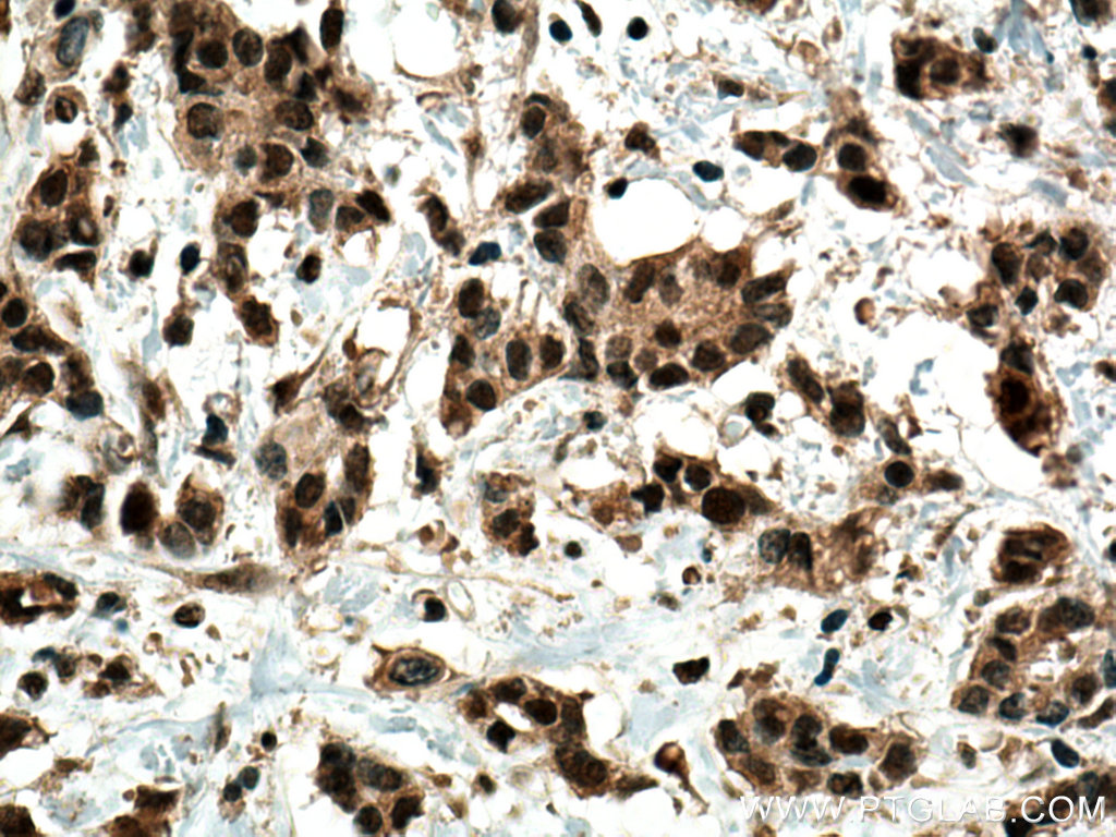 IHC staining of human breast cancer using 28245-1-AP