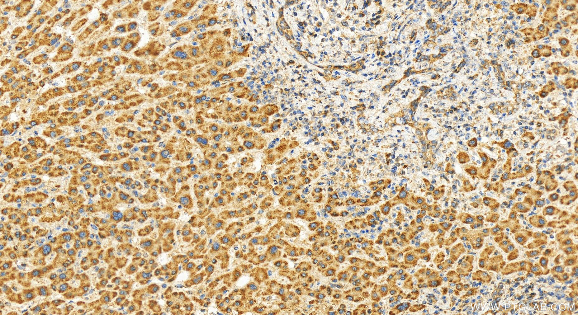 IHC staining of human intrahepatic cholangiocarcinoma using 25993-1-AP