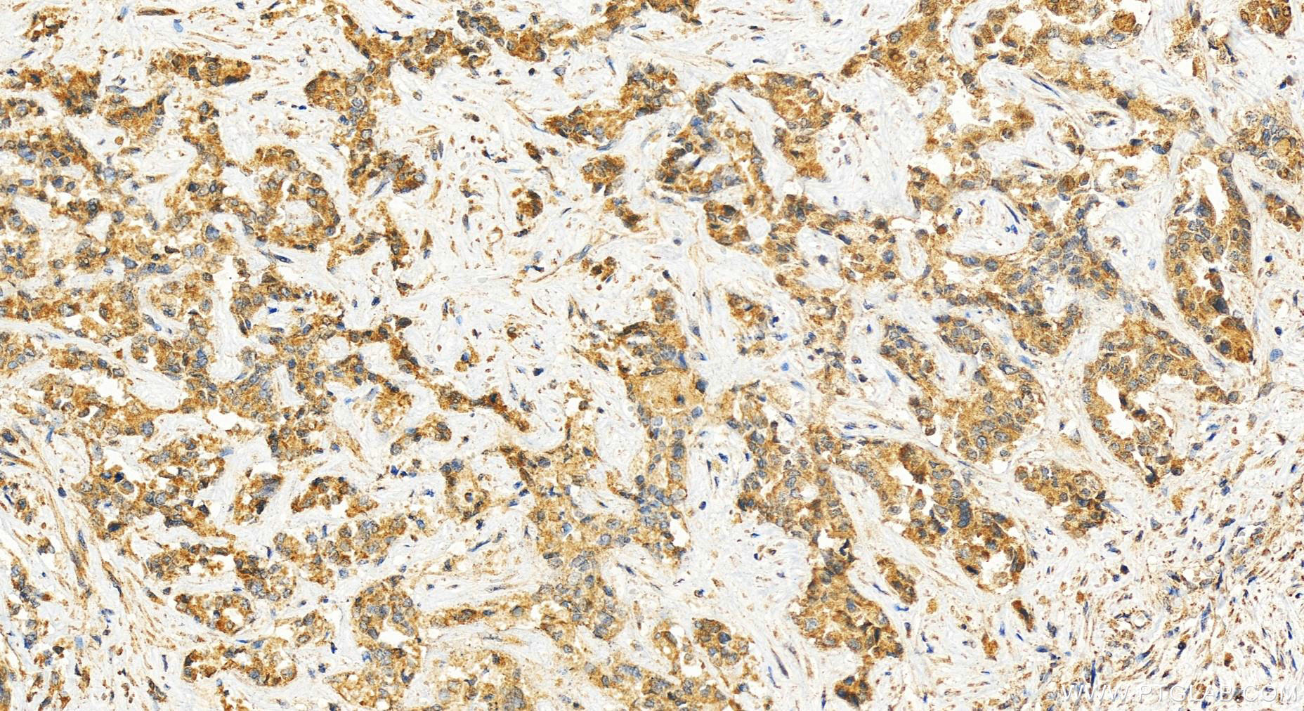 IHC staining of human intrahepatic cholangiocarcinoma using 25993-1-AP