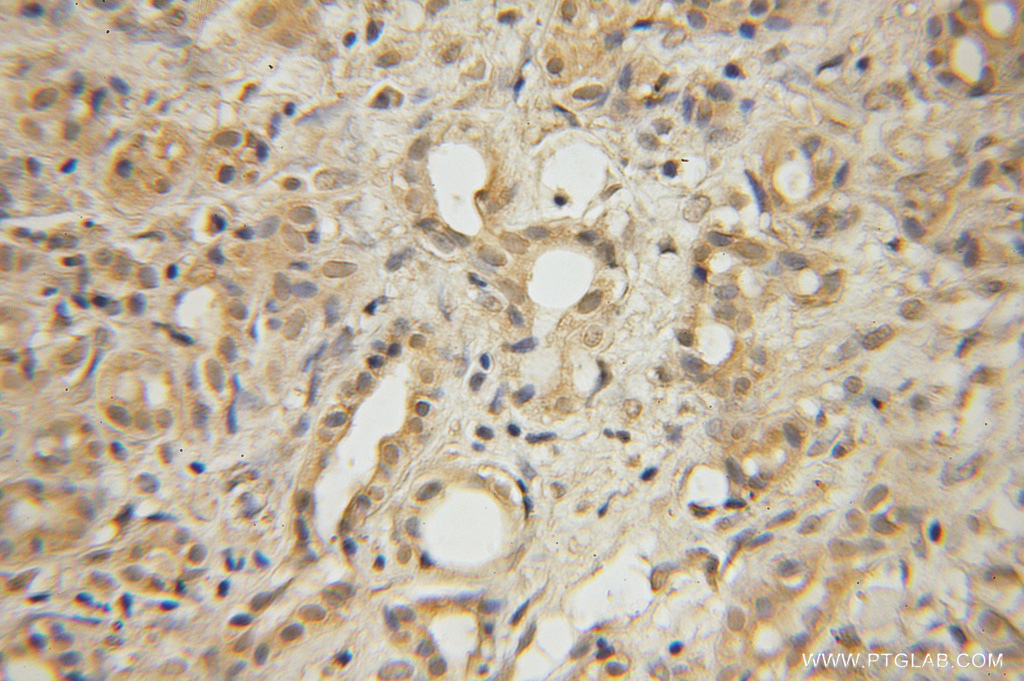 IHC staining of human pancreas cancer using 12426-1-AP