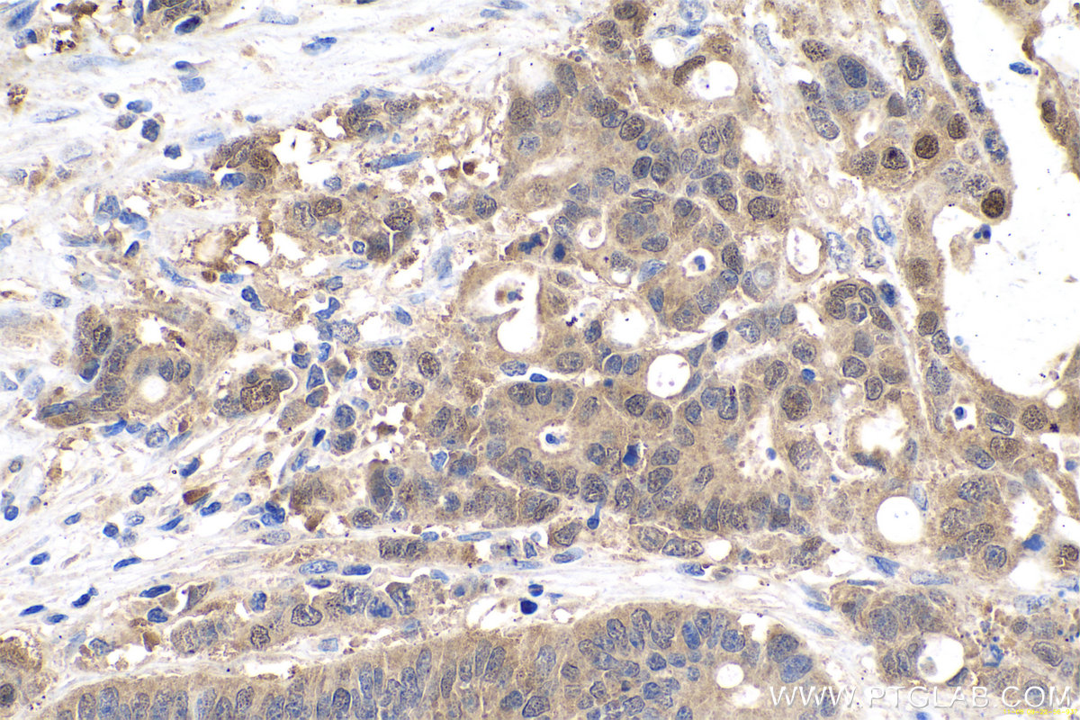 IHC staining of human colon cancer using 15442-1-AP