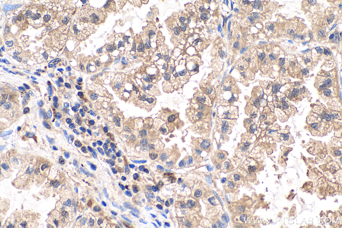 IHC staining of human lung cancer using 15442-1-AP