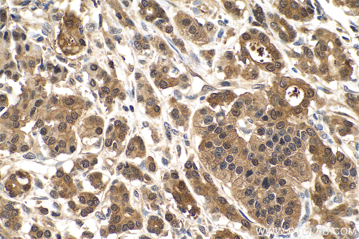 IHC staining of human pancreas cancer using 15442-1-AP