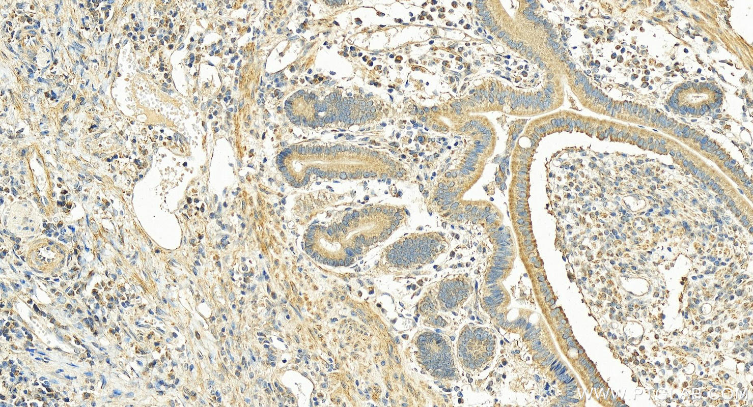 IHC staining of human stomach cancer using 25917-1-AP