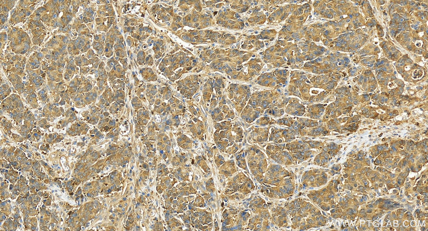 IHC staining of human stomach cancer using 15517-1-AP