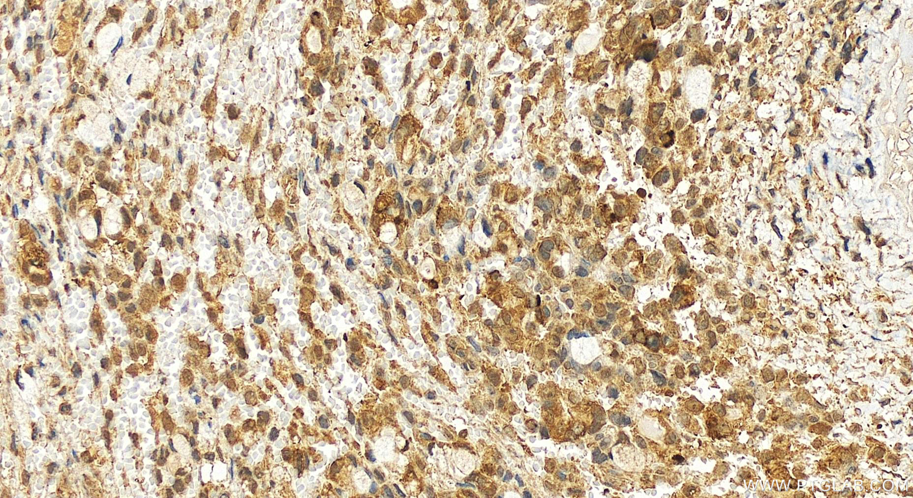 IHC staining of human ovary cancer using 15094-1-AP