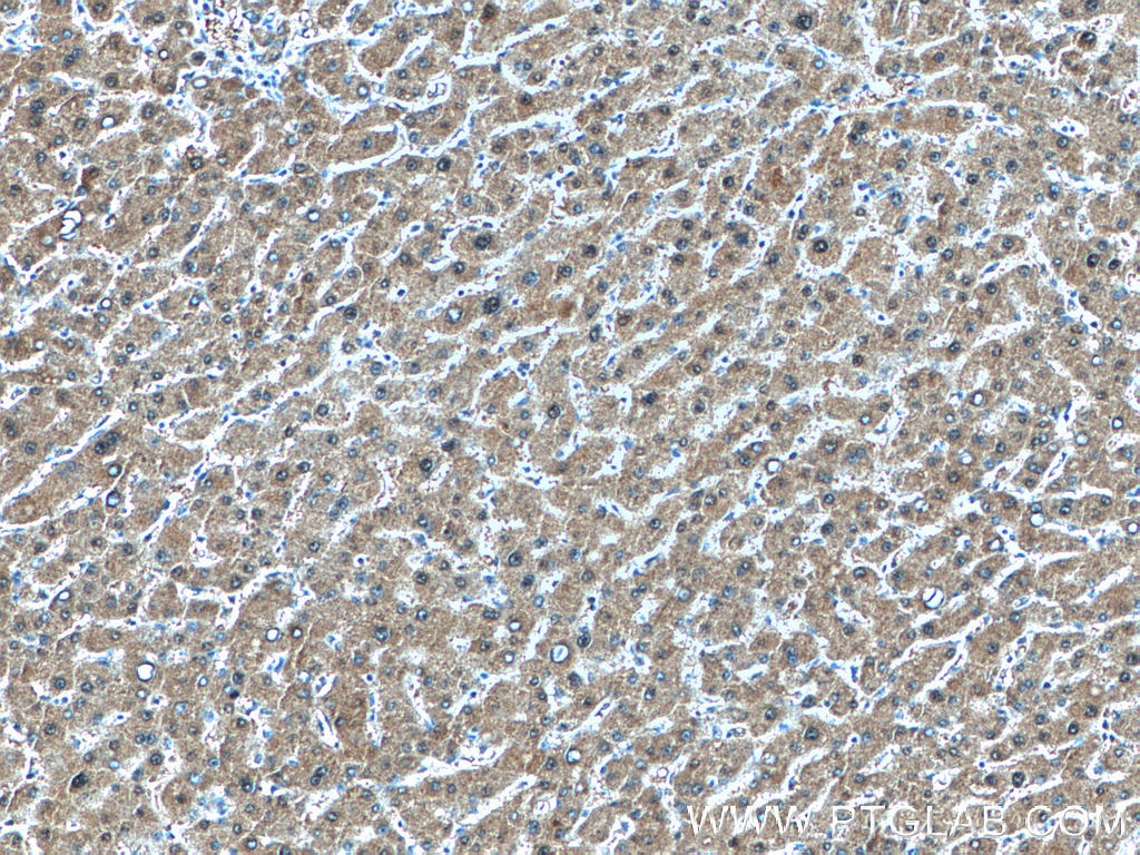 IHC staining of human liver cancer using 16376-1-AP