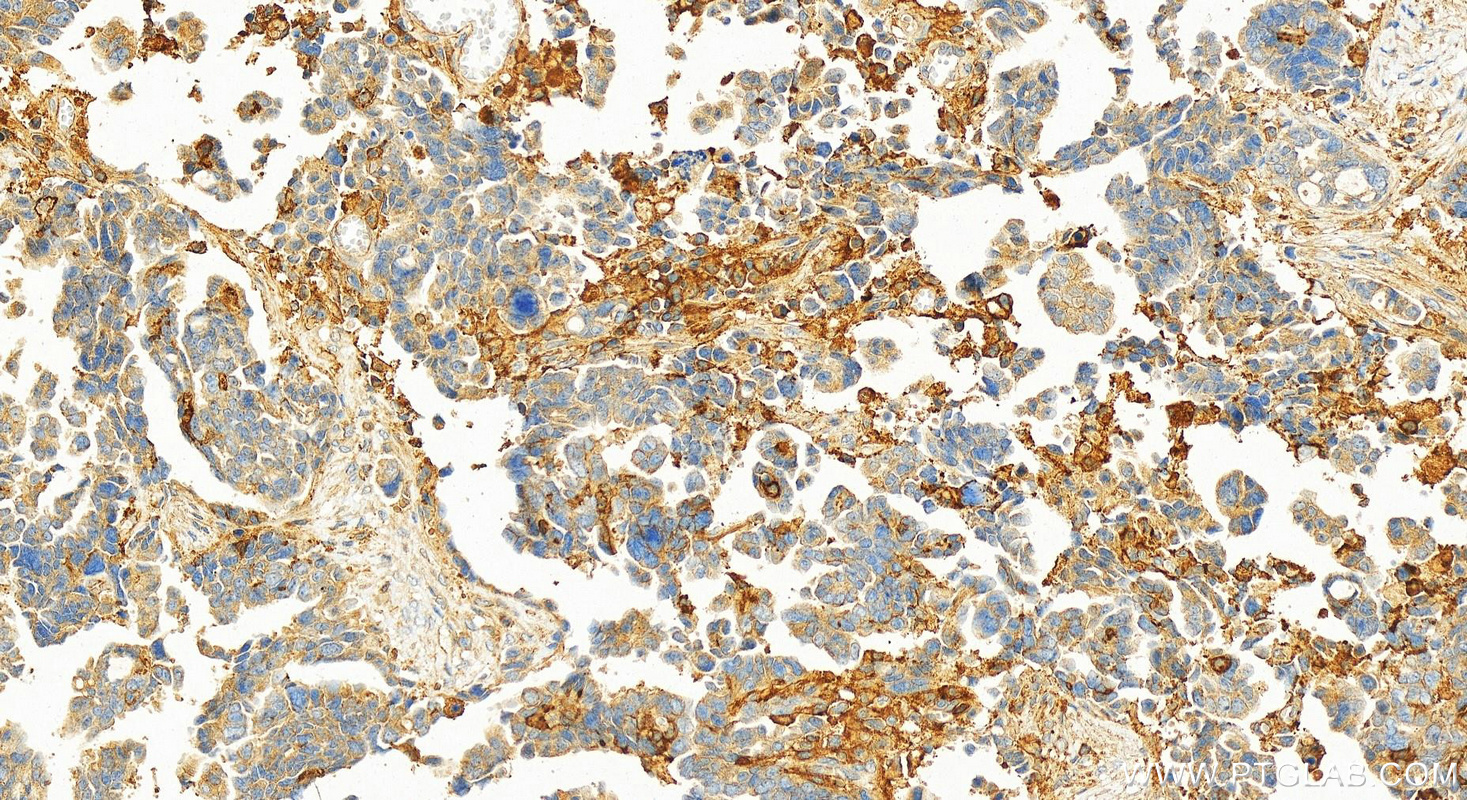 IHC staining of human ovary cancer using 11136-1-AP