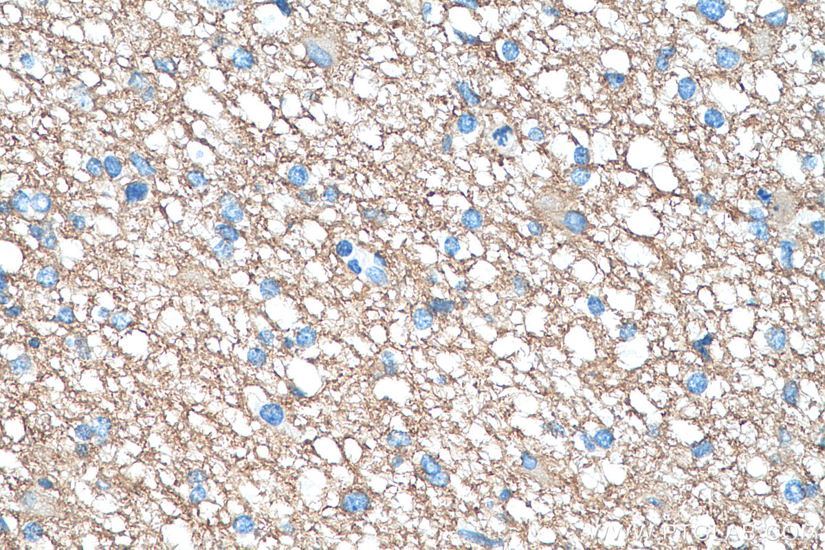 IHC staining of human gliomas using 68027-1-Ig (same clone as 68027-1-PBS)