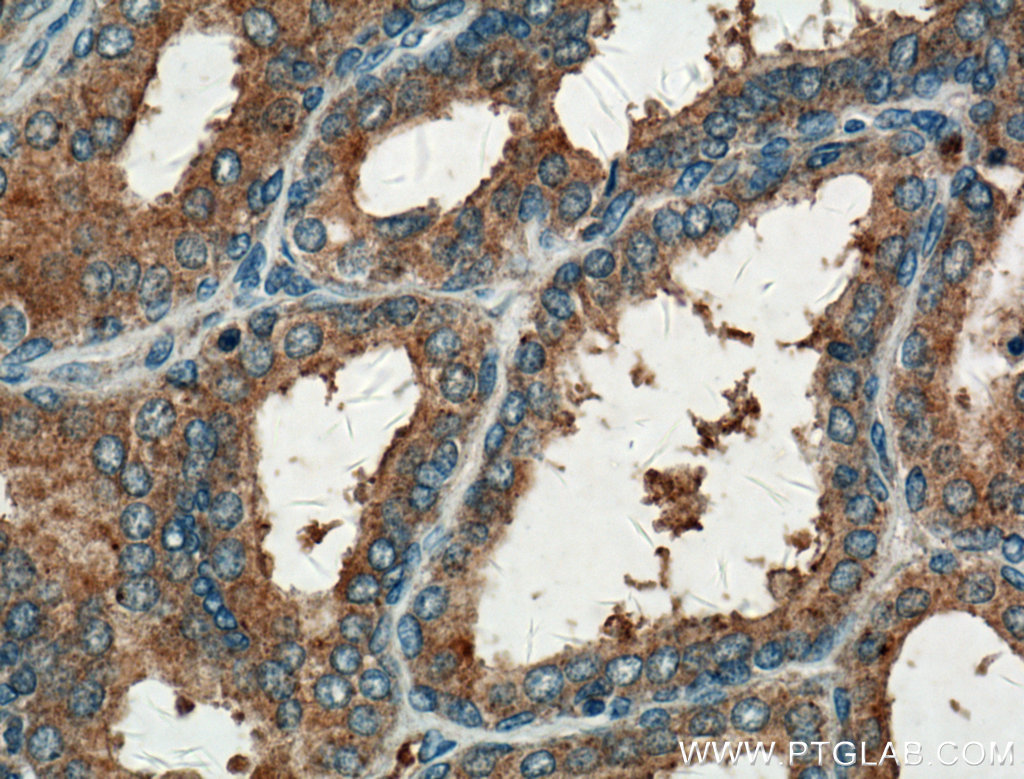 IHC staining of human prostate hyperplasia using 18790-1-AP