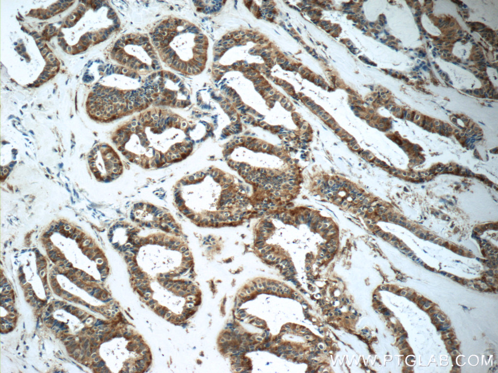 IHC staining of human breast cancer using 17105-1-AP