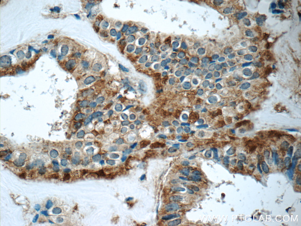 IHC staining of human breast cancer using 17105-1-AP