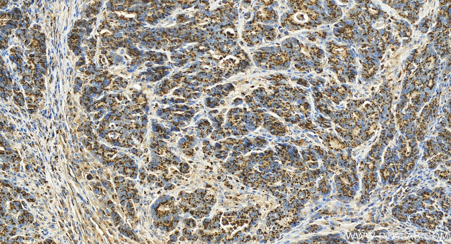 IHC staining of human stomach cancer using 15126-1-AP