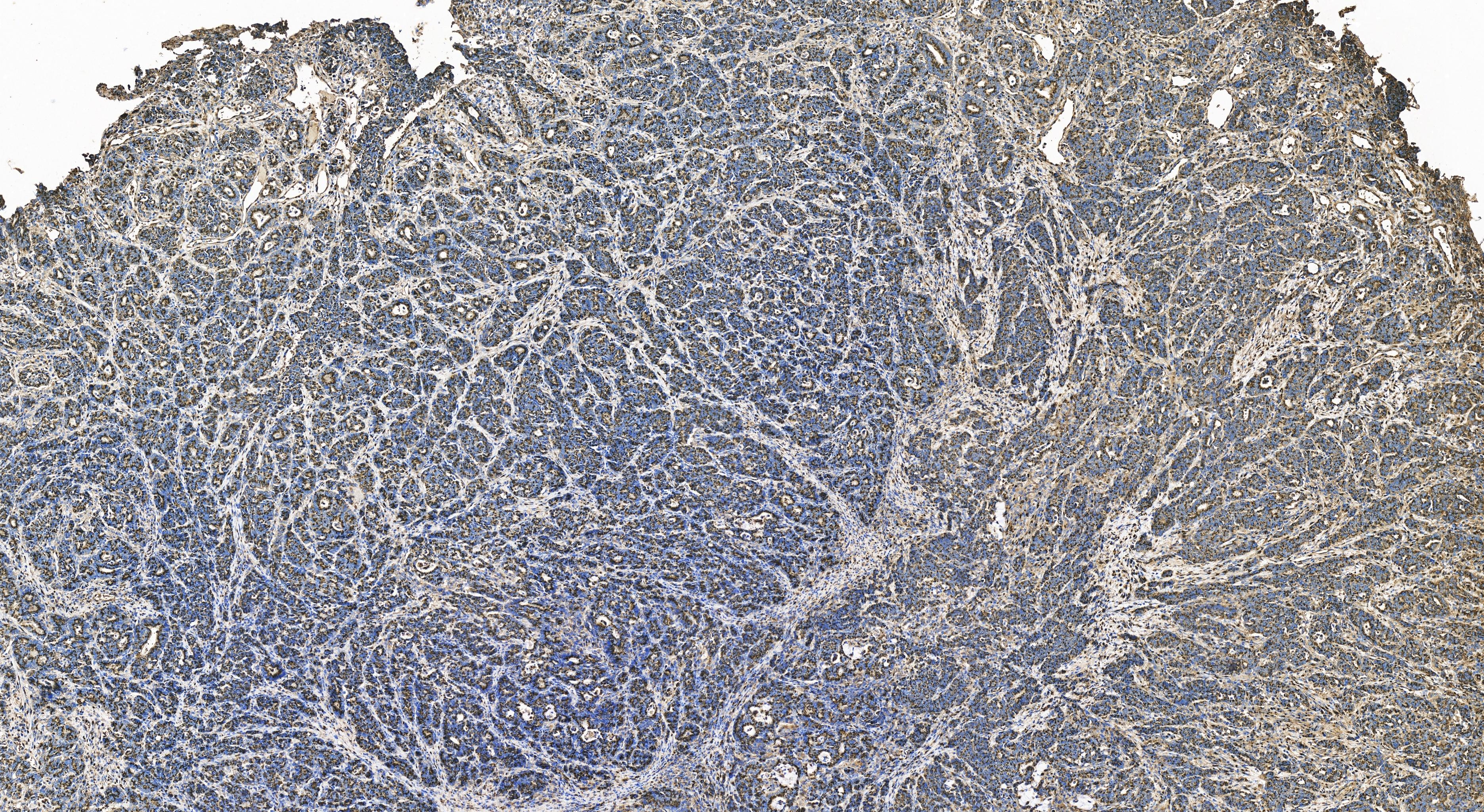 IHC staining of human stomach cancer using 81893-1-RR